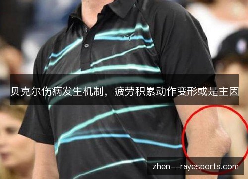 贝克尔伤病发生机制,疲劳积累动作变形或是主因 贝克尔伤病发生机制,疲劳积累动作变形或是主因